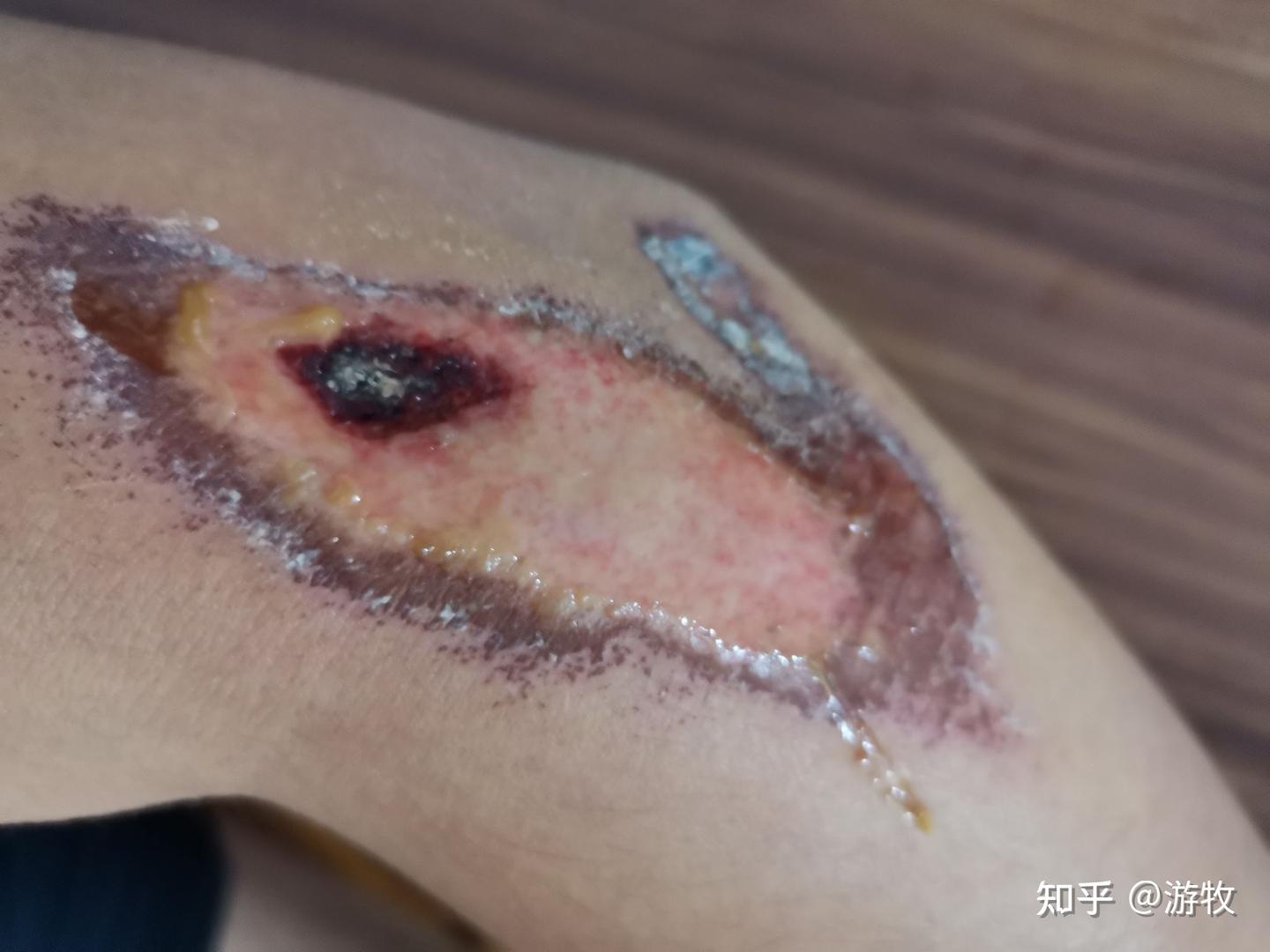 表皮擦伤及疤痕处理 - 知乎