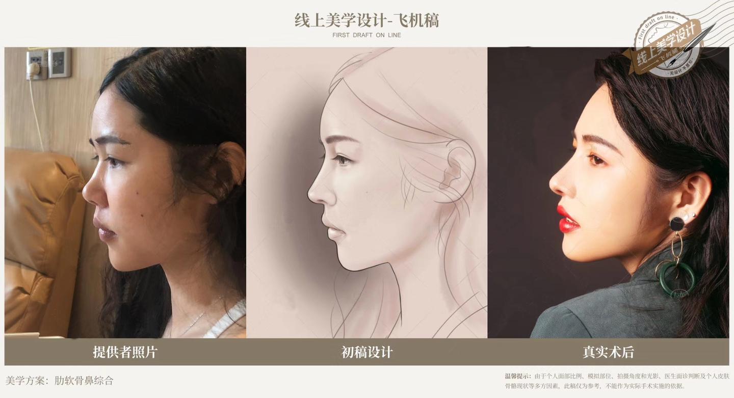 隆鼻哪里好 有推荐的吗 知乎 隆鼻哪里好 有推荐的吗 知乎