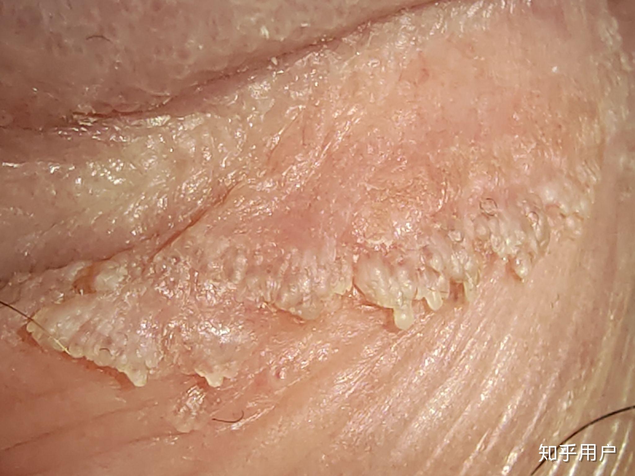 鸡儿长尖锐湿疣是怎样一种体验? - 知乎