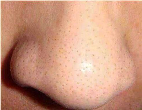 小策护肤随笔八认识假黑头皮脂腺丝