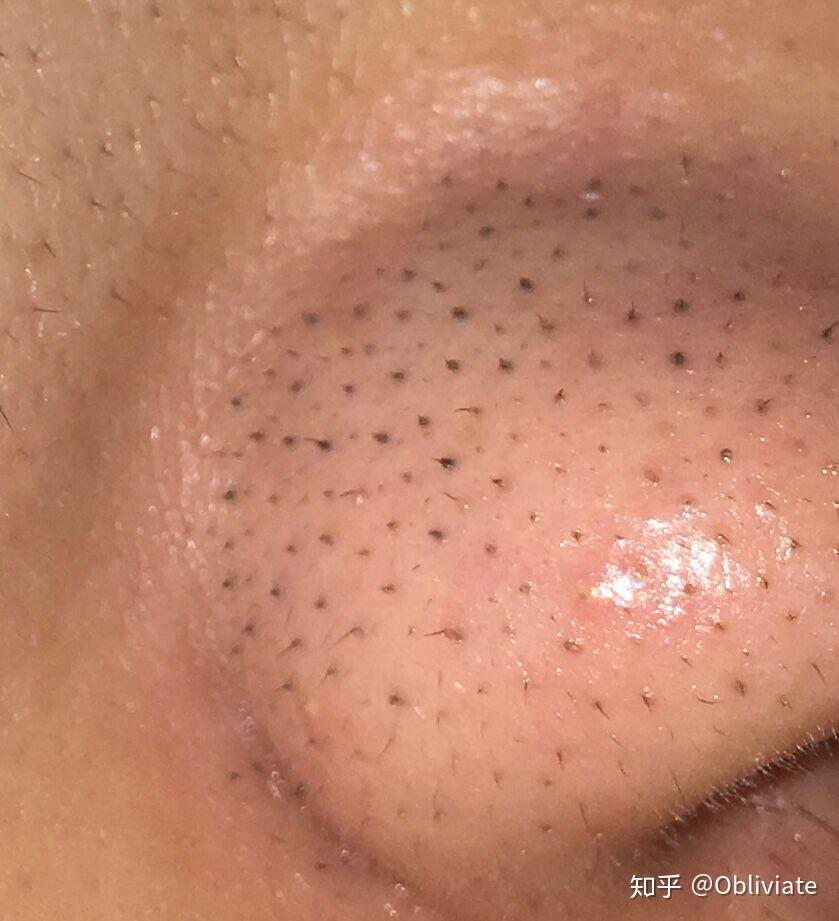 请问大家这是假的黑头吗如果是假的是哪一类呢