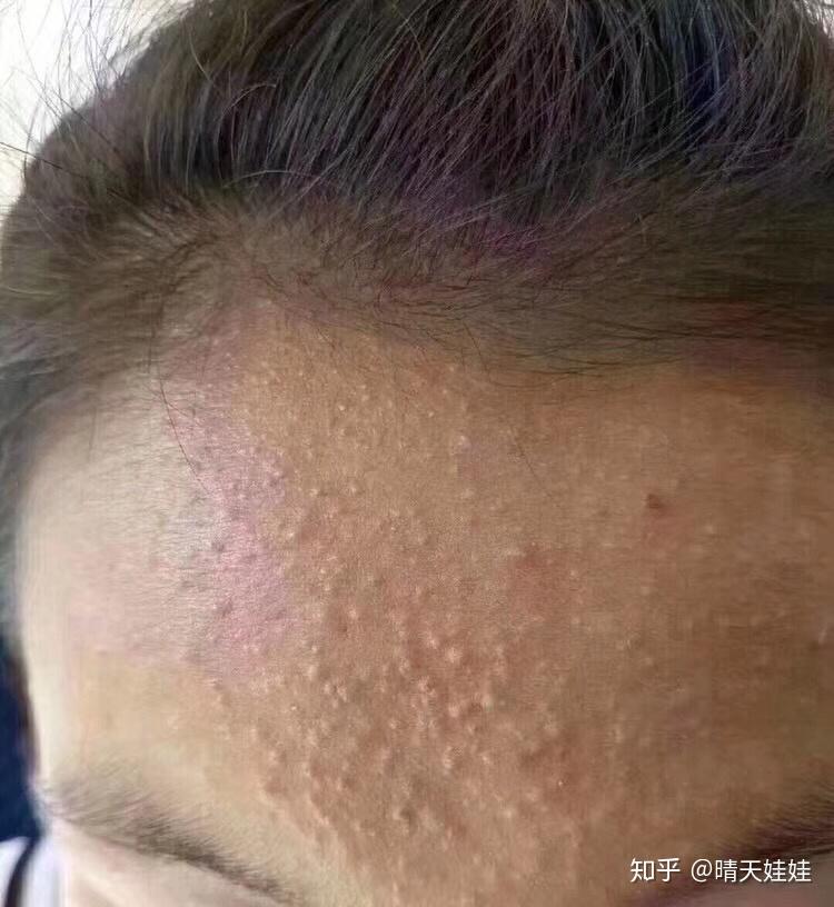 闭合性粉刺产生的原因