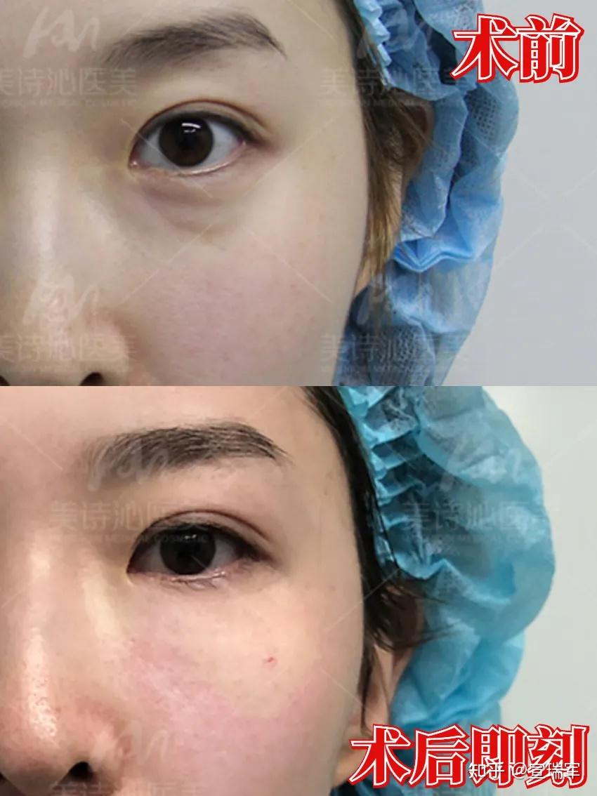 去眼袋手术照曝光!原来这才是真实的效果67