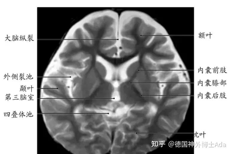 脑基底节区解剖图图片