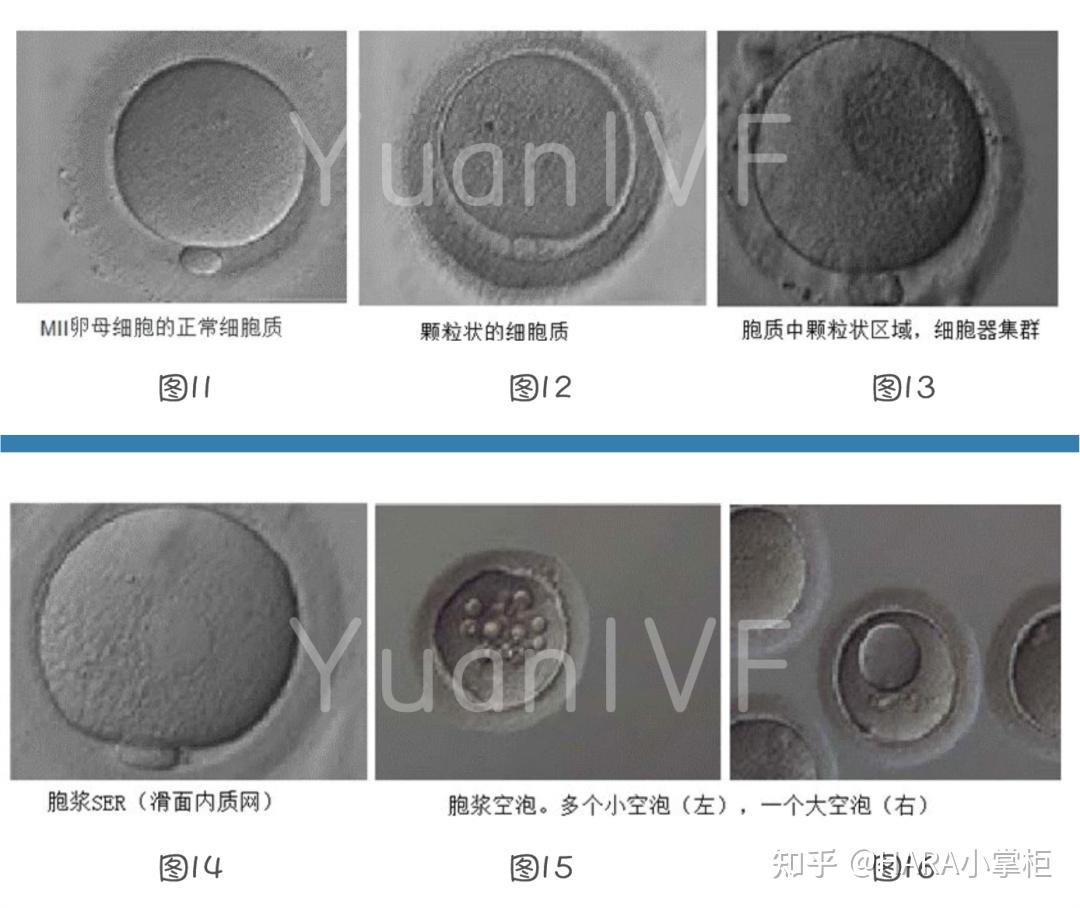 4)透明带异常透明带是环绕在哺乳动物卵母细胞周围的细胞外衣,它在