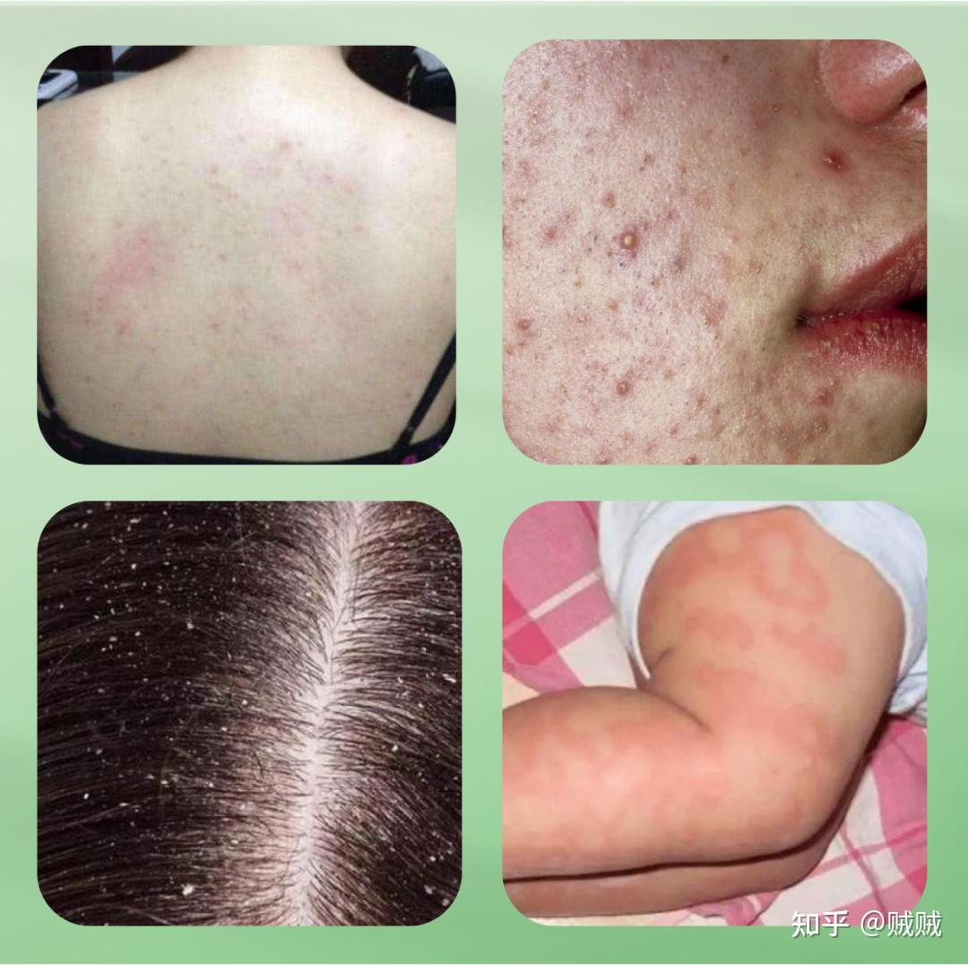 晚可能有几十万只螨虫陪你睡觉,看到这鸡皮疙瘩瞬间掉一地 - 知乎