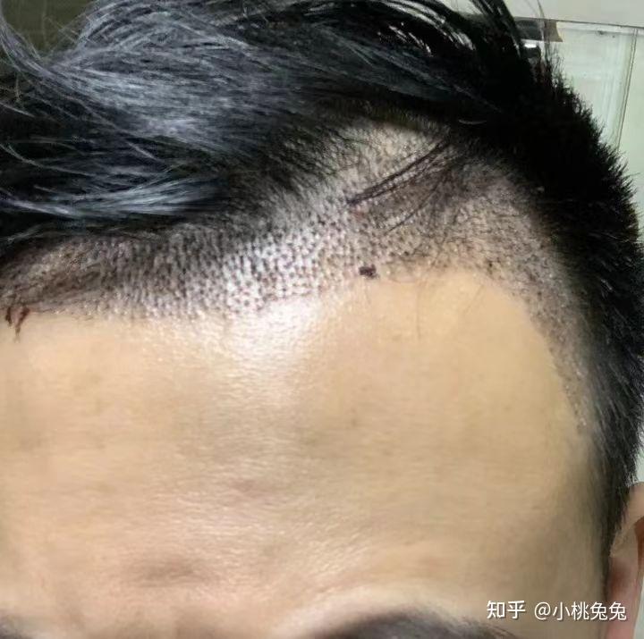 植发恒博(恒美植发医院怎么样)