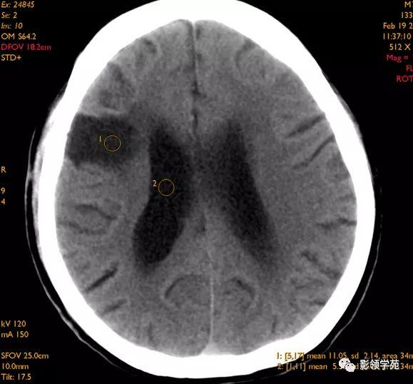 脑梗死影像学表现图片