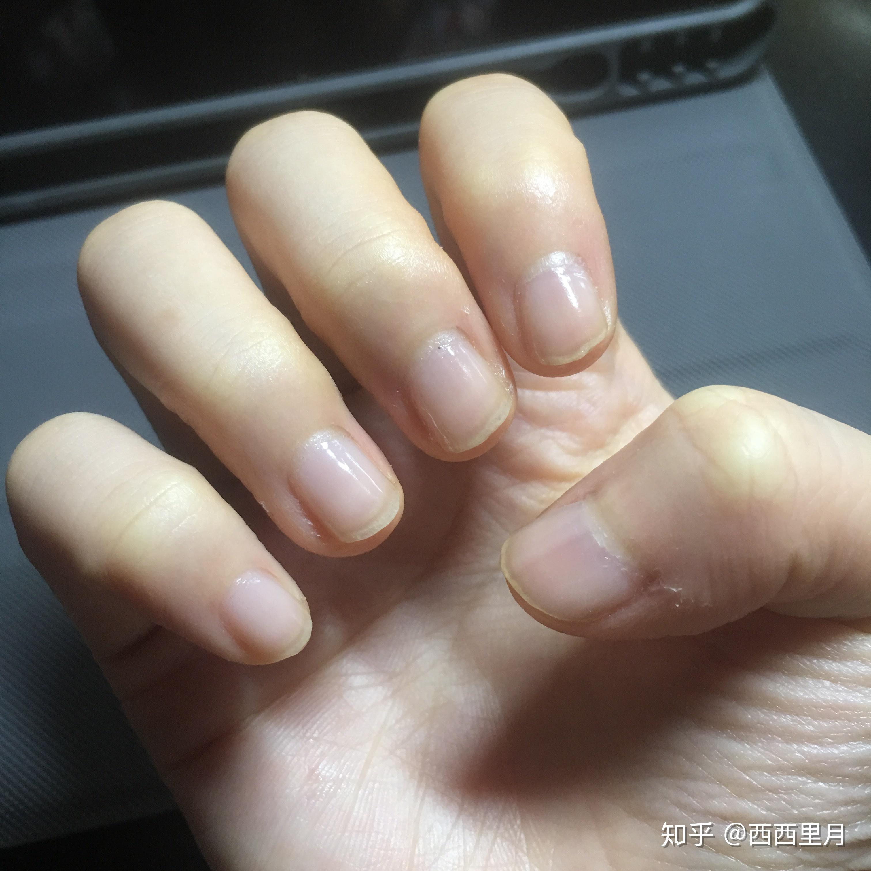 手指甲被咬的超级短怎么办