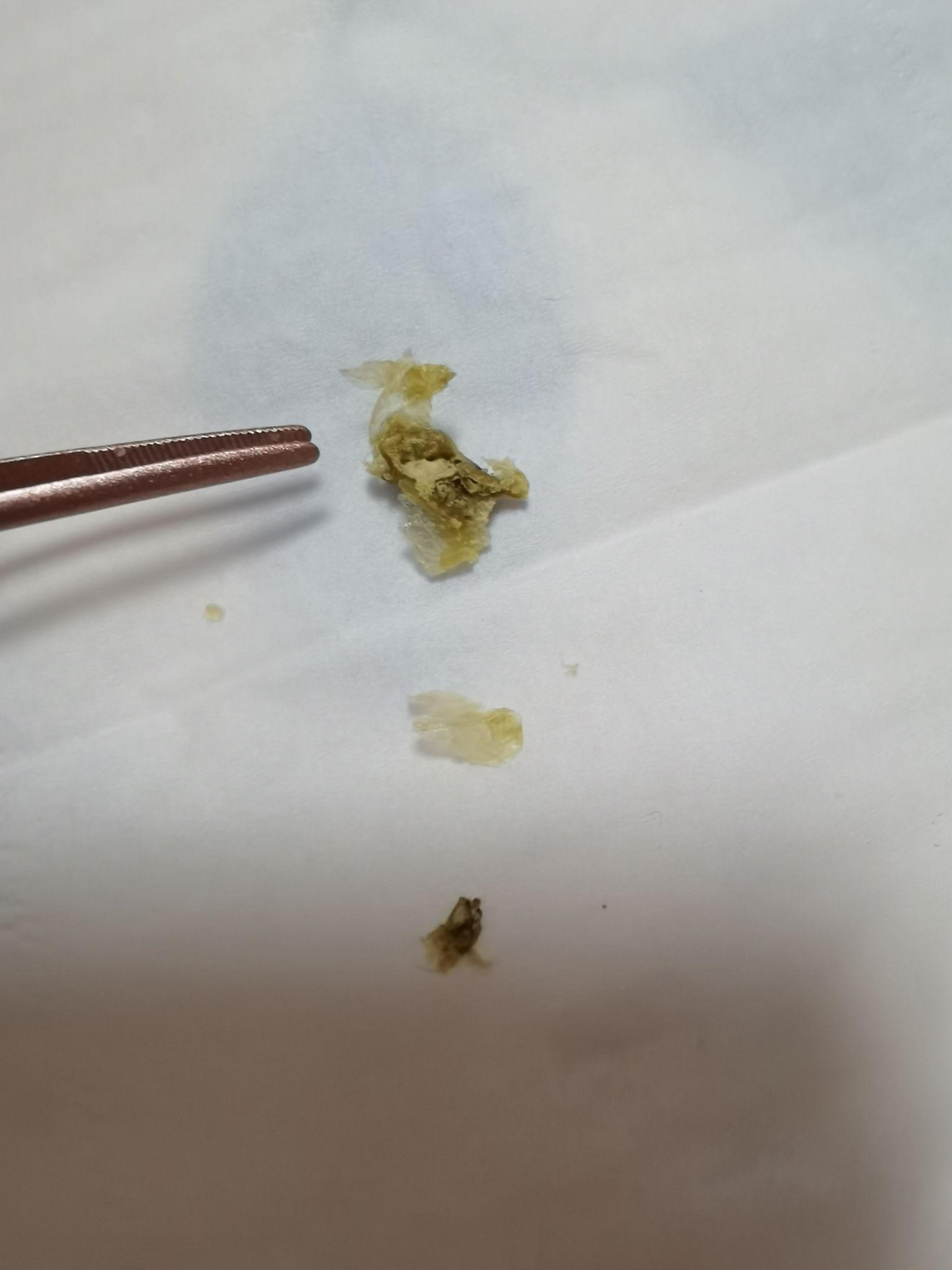 最大的头皮屑有多大图片