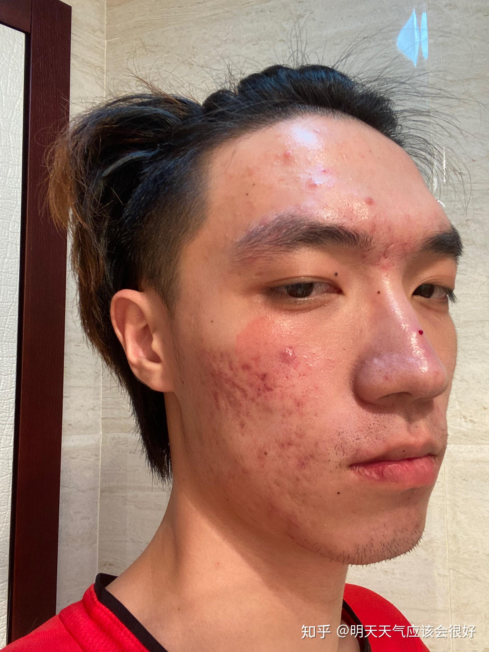吃异维a酸软胶囊对治疗重度痤疮有效吗?对身体有什么影响? - 知乎