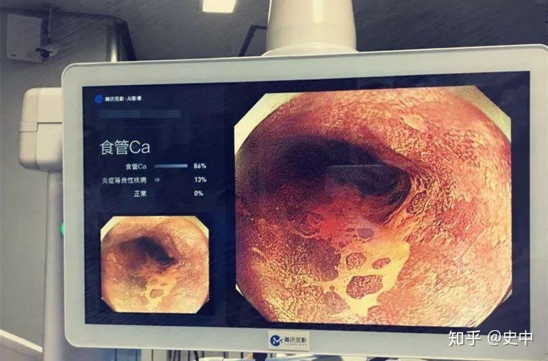 v2-8fb81e21cbdc09a3af76b0c1dd5c822c_b.jpg 互联网巨头如何用医疗AI回答尊严与生命之问?