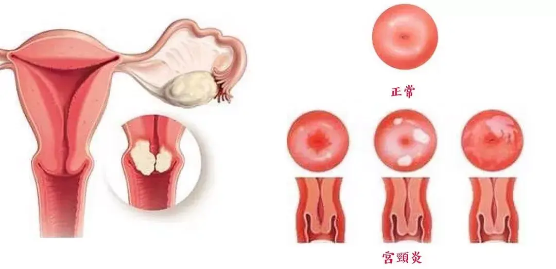 目前,「宫颈糜烂」这个名称已经被正式取消,改为「宫颈柱状上皮异位」