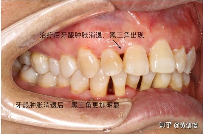 全面解析"正畸后遗症"——黑三角