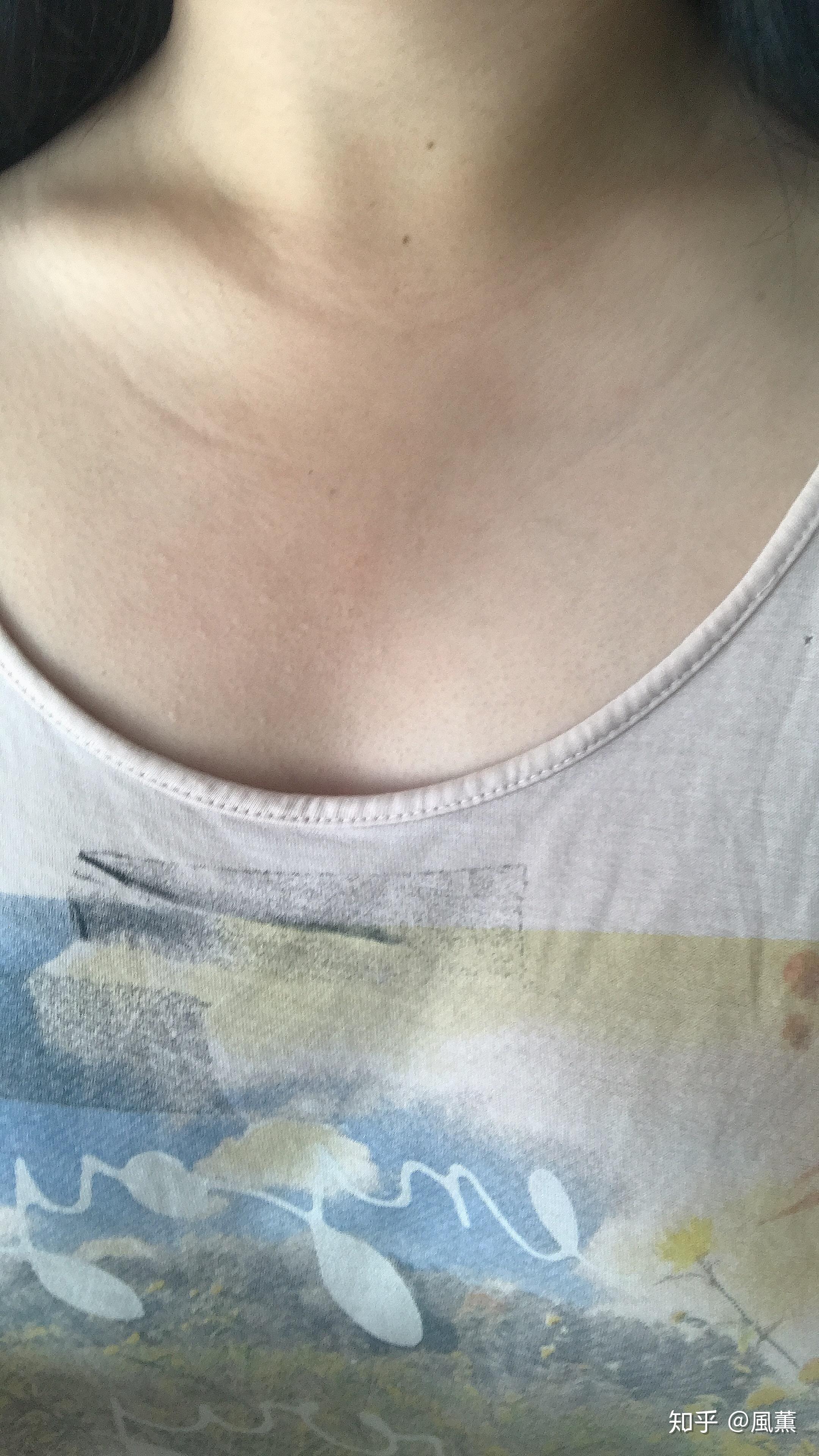 为什么锁骨附近的皮肤有纹路