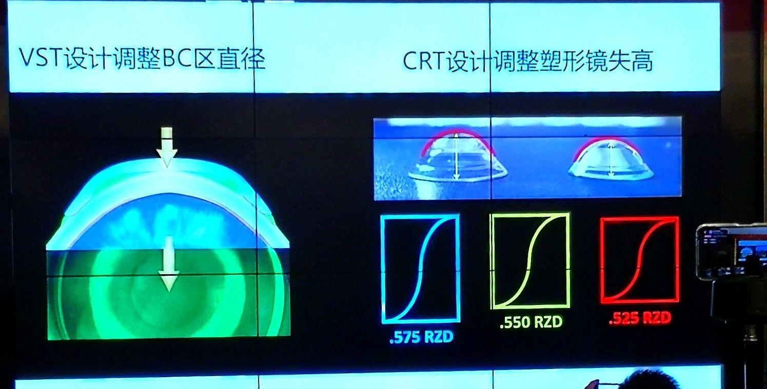 vst設計調整bc區直徑crt設計調整塑形鏡矢高調整rzd後