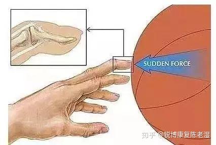 打篮球手指挫伤该如何处理?