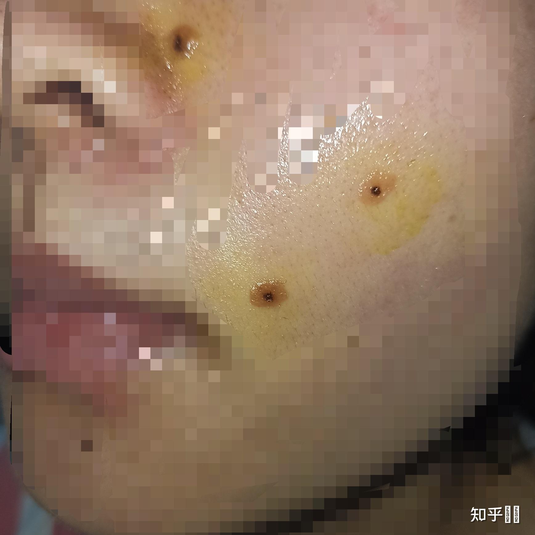 想问一下有没有做过冷冻点痣的? - 知乎