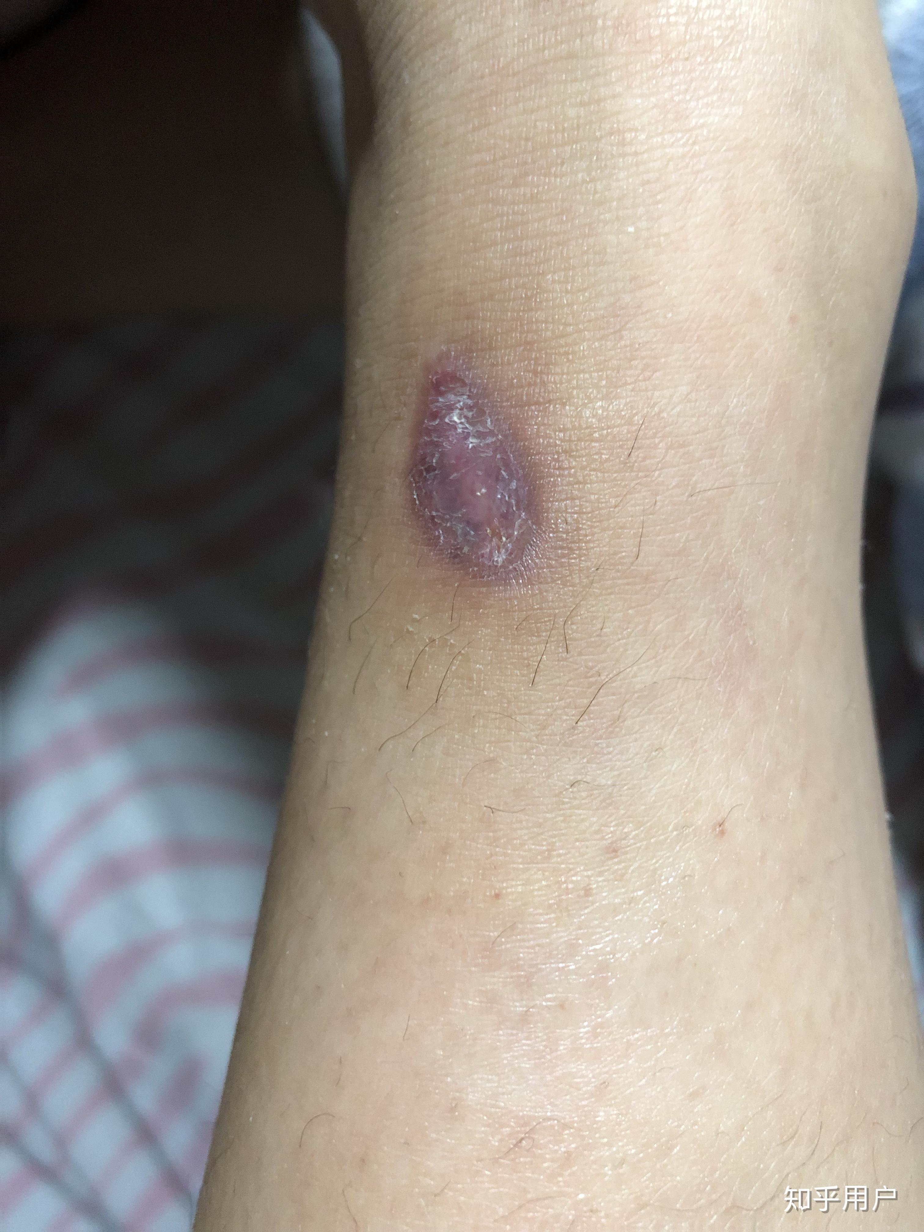 被毒蚊子咬了肿了很大一个包还很硬之后肿的包上面起了水泡挑破之后第