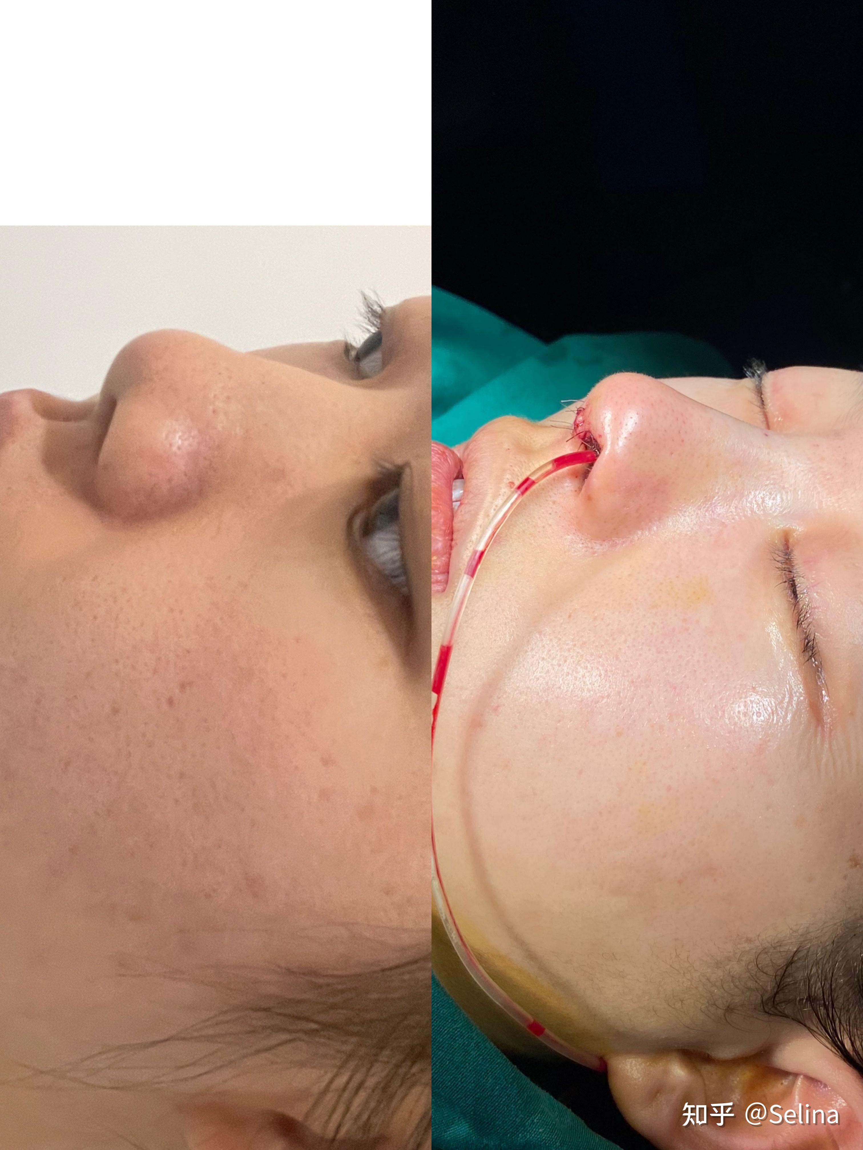 我每天都有在吃各种消肿药消脱止啥的 山根还没消,但是我就是觉得鼻子