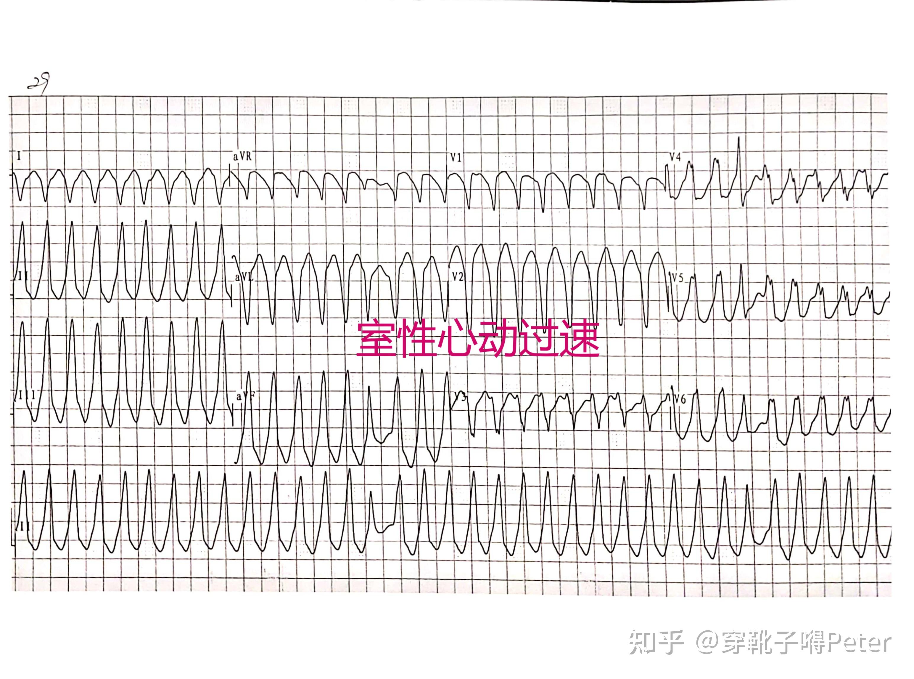 60种常见心电图一览第三篇室性心率失常