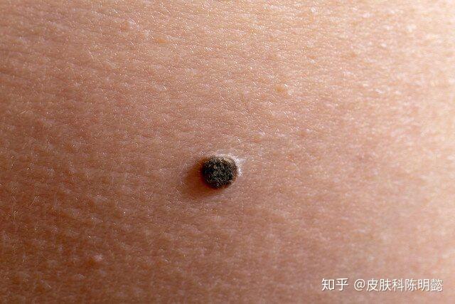 黑色素瘤什么样子怎么办