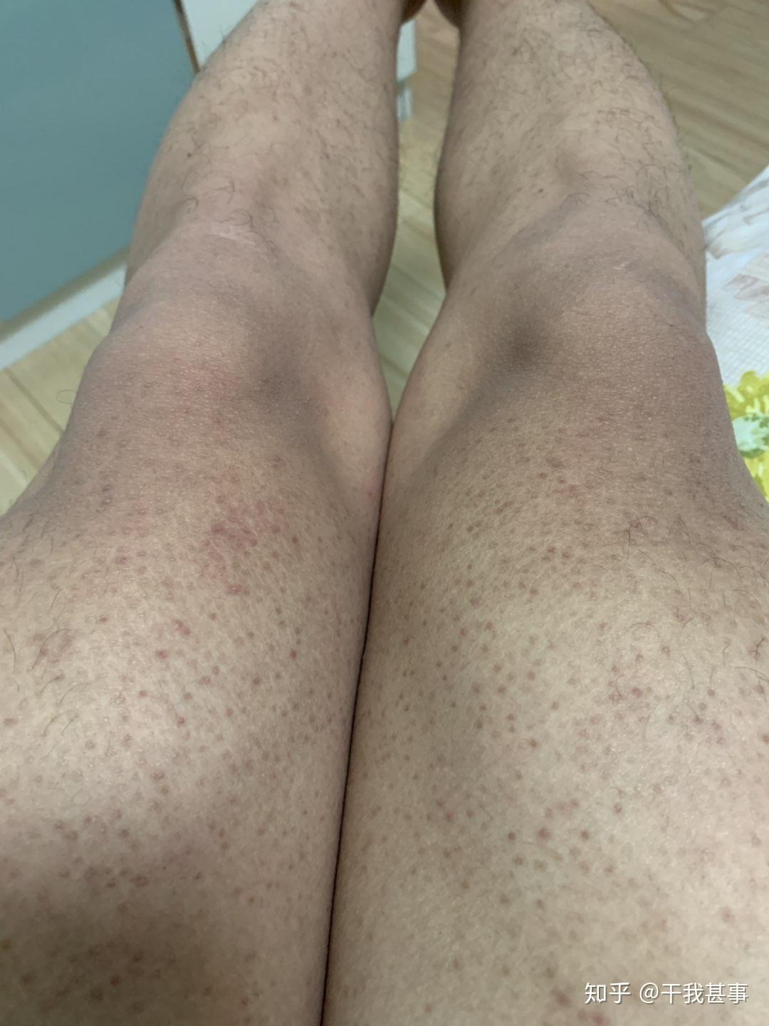 你是如何改善毛周角化(鸡皮肤)和鱼鳞病的? - 知乎