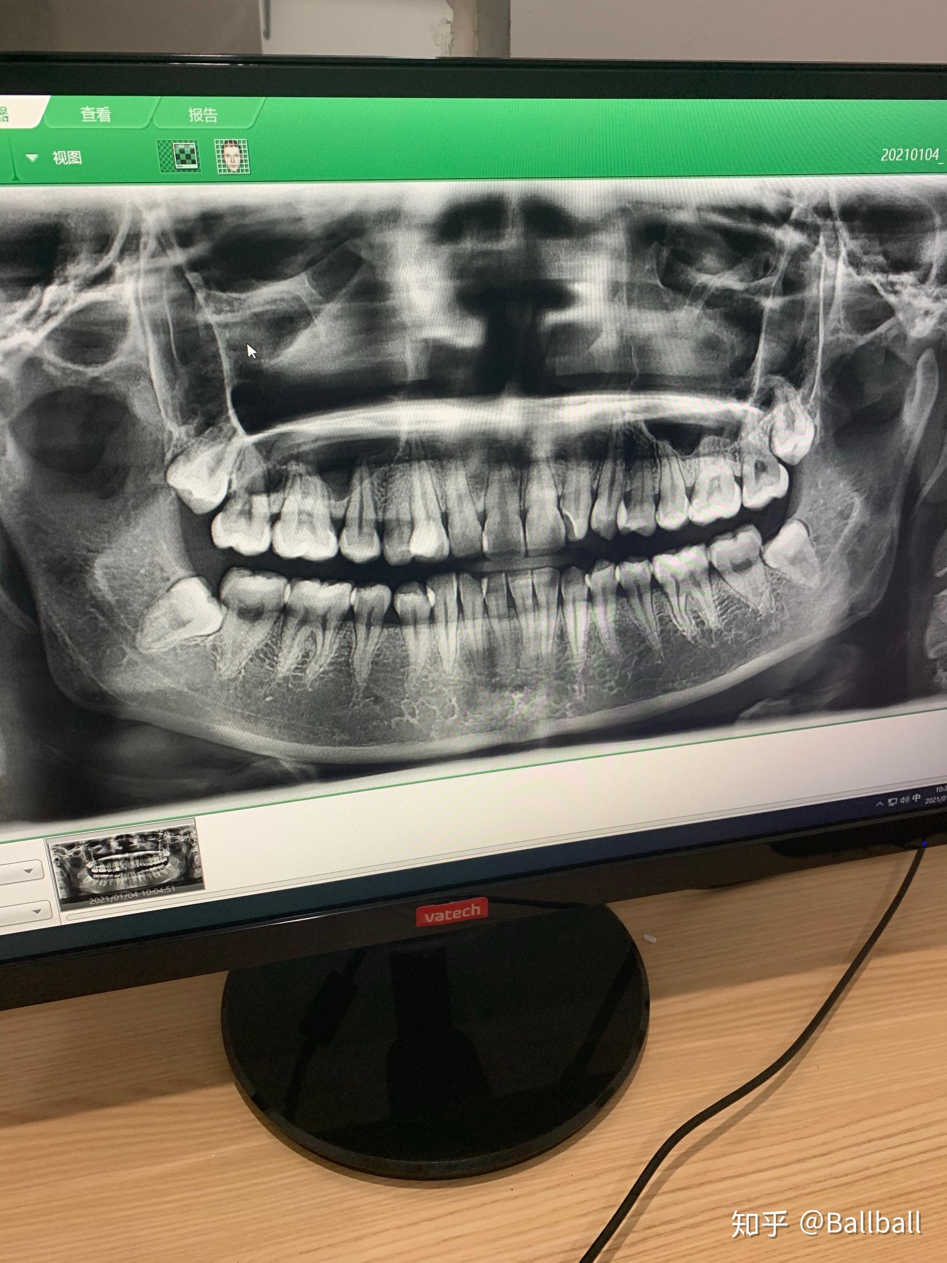 正常牙齿ct图片图片