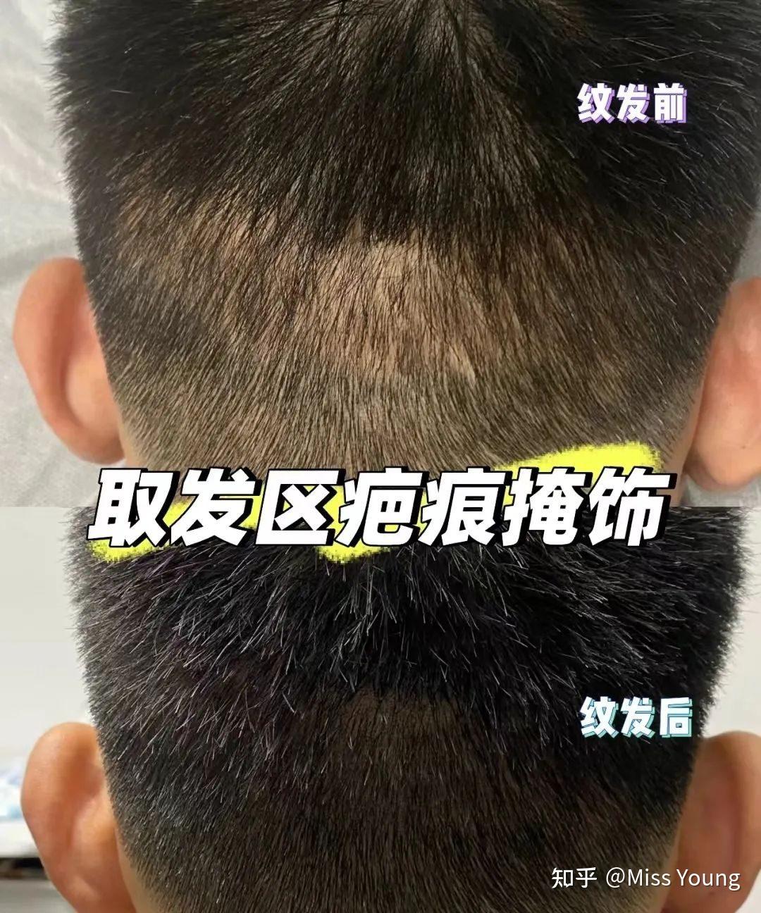 全球植发之都：一个适合种头发做发际线的国家！ - 知乎