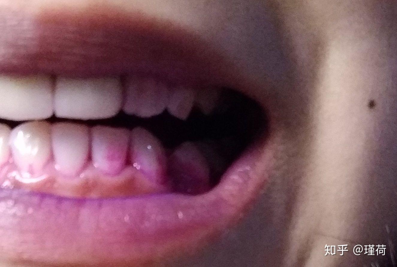 日本ci儿童成人齿垢染色剂小宝宝牙菌斑显示剂指示剂正畸_虎窝淘