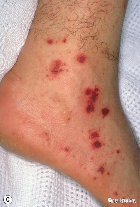 过敏性紫癜有什么特征?如何才能不误诊