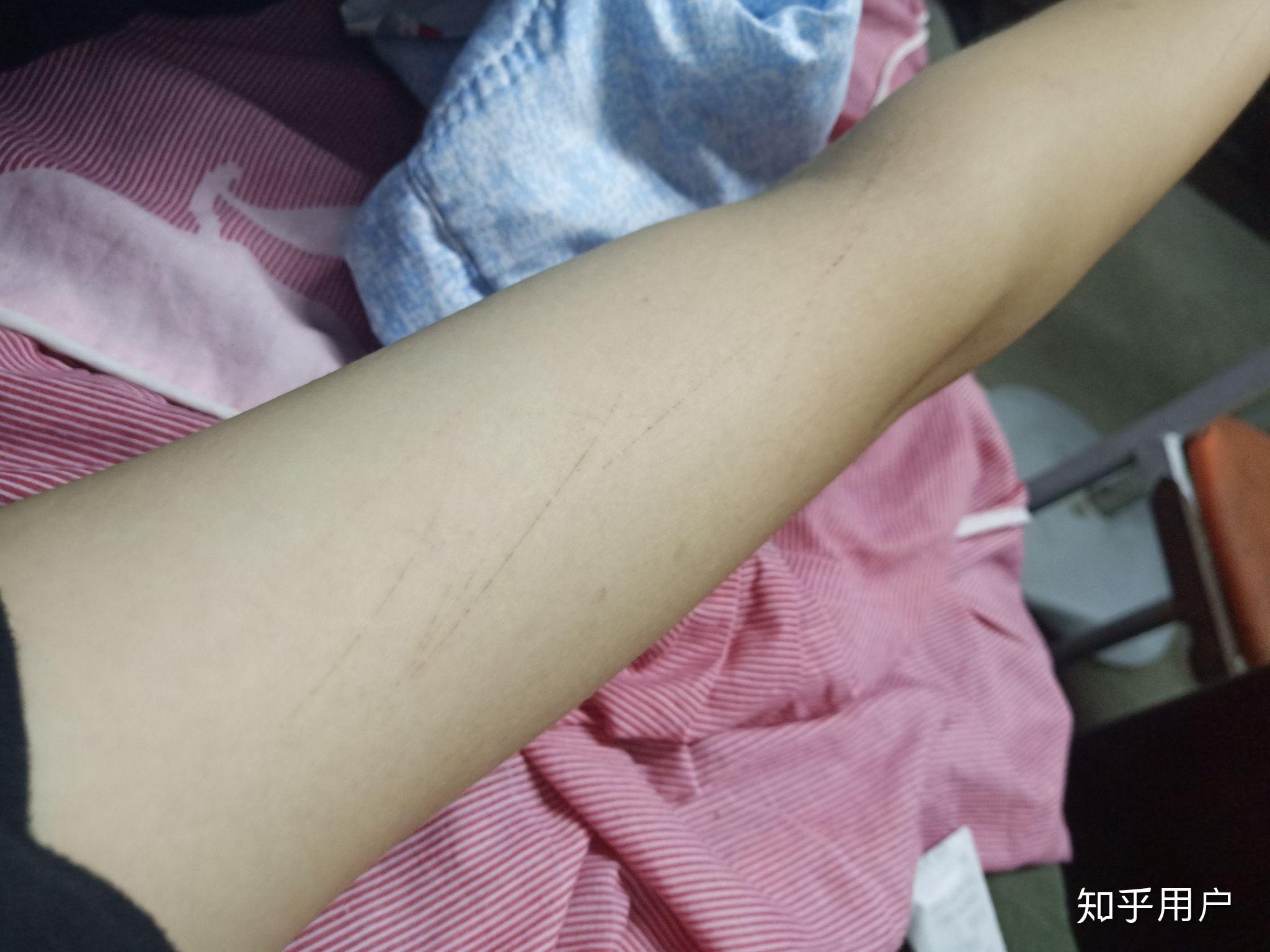 手臂莫名其妙出现伤痕是怎么回事?