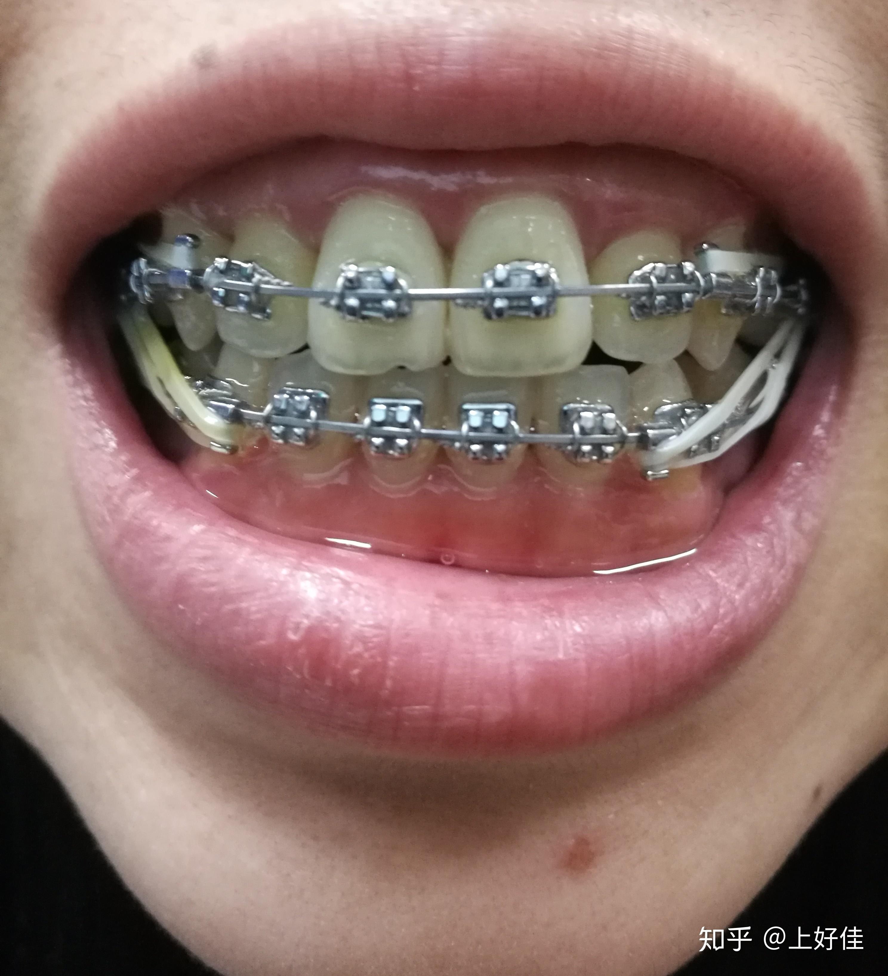 全同步带状弓整牙日记每周一更