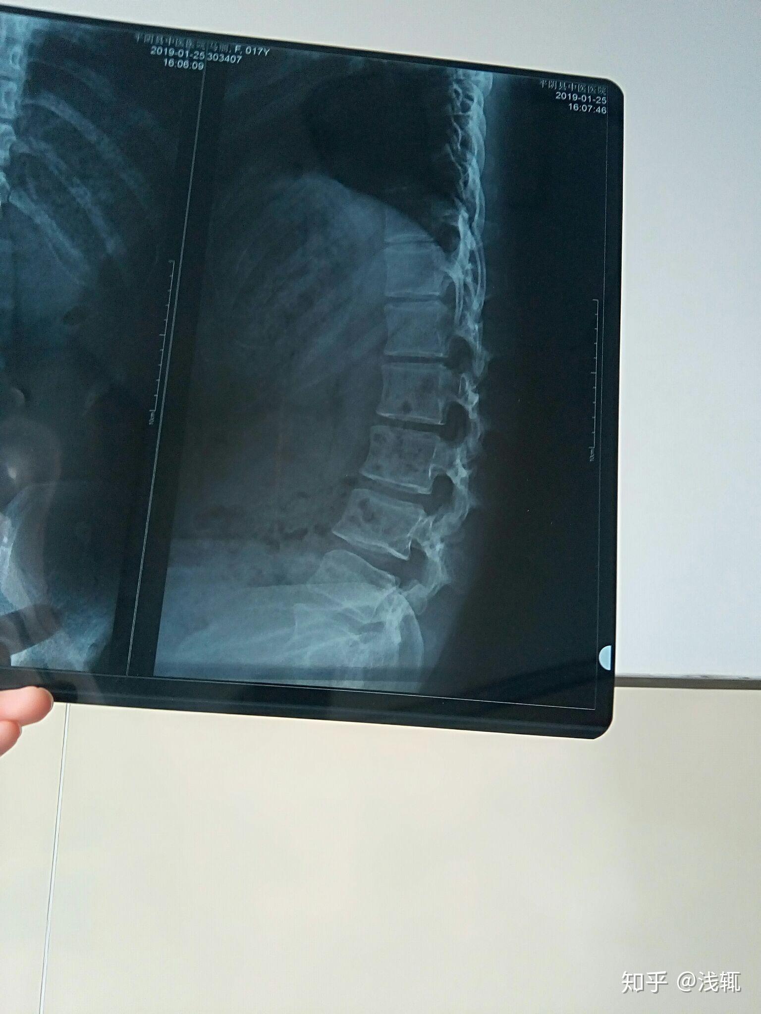 先天腰间盘突出,脊柱达到45度弯曲的人有多痛苦?