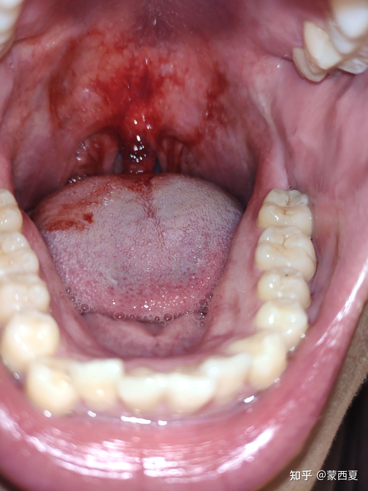 舌乳头状瘤怎么办图片