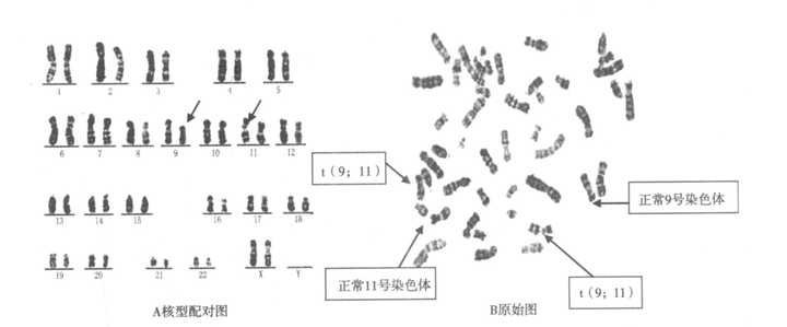 染色体平衡易位携带,自怀还是三代试管?试管成功率高吗? - 知乎