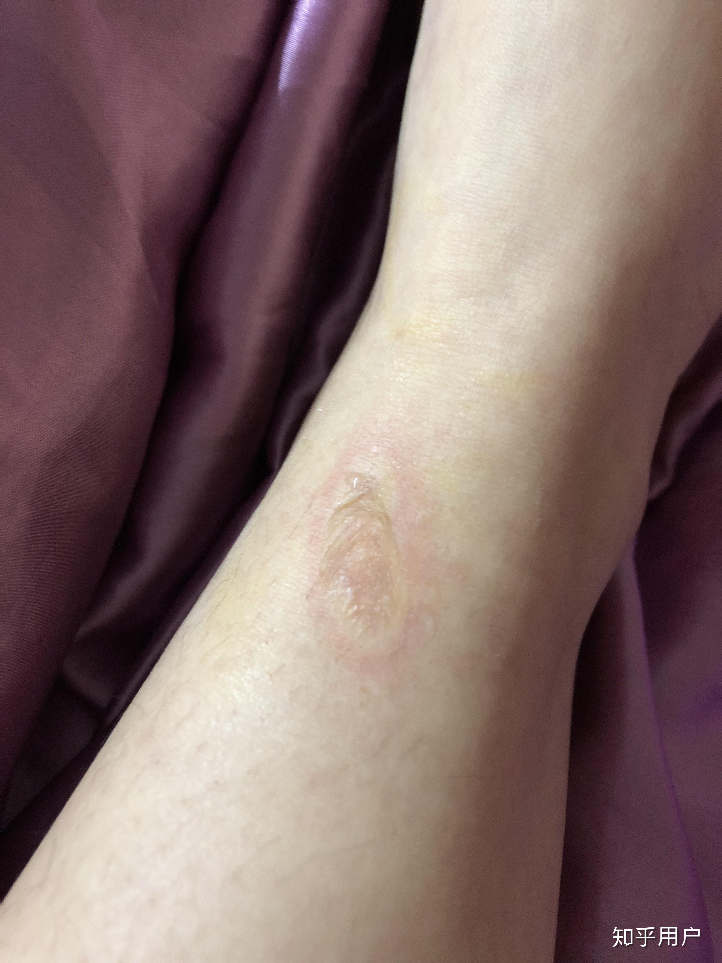 被毒蚊子咬了肿了很大一个包还很硬之后肿的包上面起了水泡挑破之后第