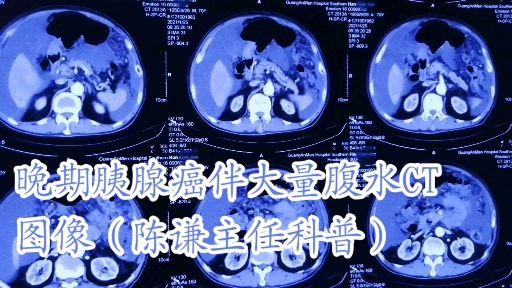 陈谦主任科普之晚期胰腺癌大量腹水ct图像 发布于 2021