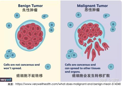 良性肿瘤与恶性肿瘤的本质区别是什么? - 知乎