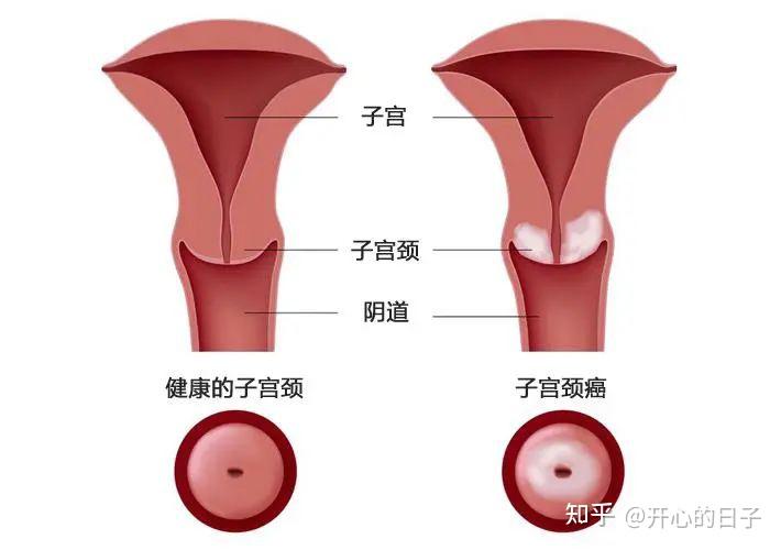 子宫的体壁有三层组织,外面被腹膜所覆盖,叫作浆膜层,子宫腔内侧由
