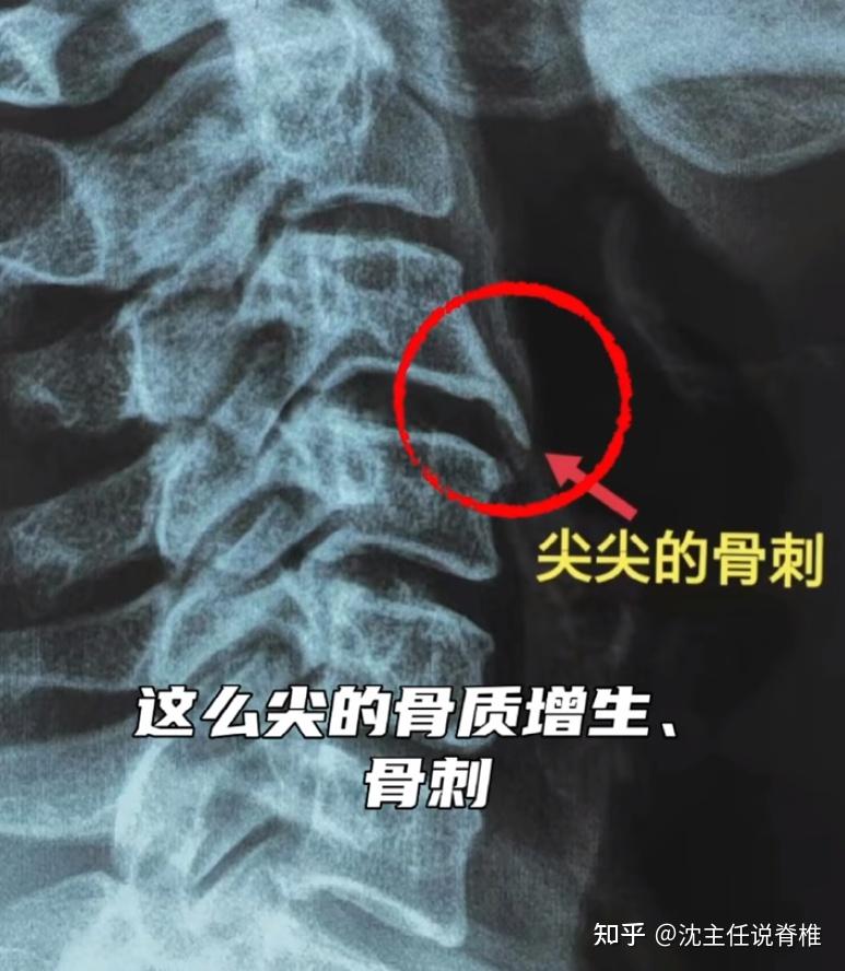 颈椎骨质增生如何治疗? - 知乎