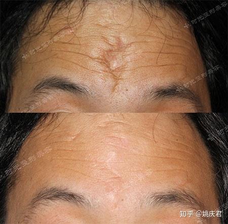 脸上的疤痕,老疤,二十多年了.有没有治疗效果明显的手术或医院推荐?