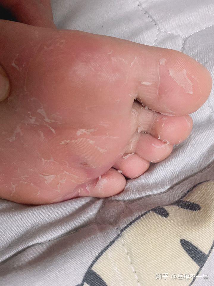脚上老长水泡,脱皮,据说是脚气真菌感染! 