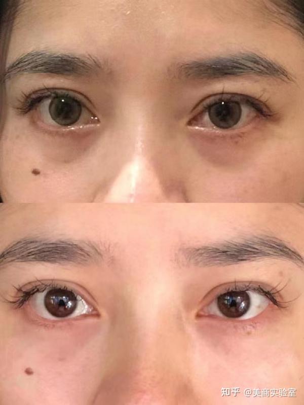 三,去泪沟的解决方法