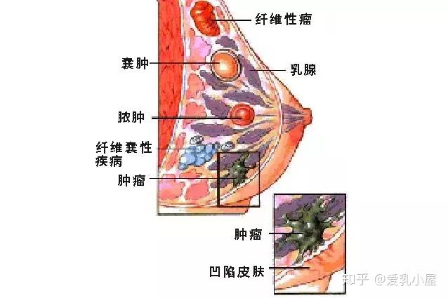 乳房包块正常图片