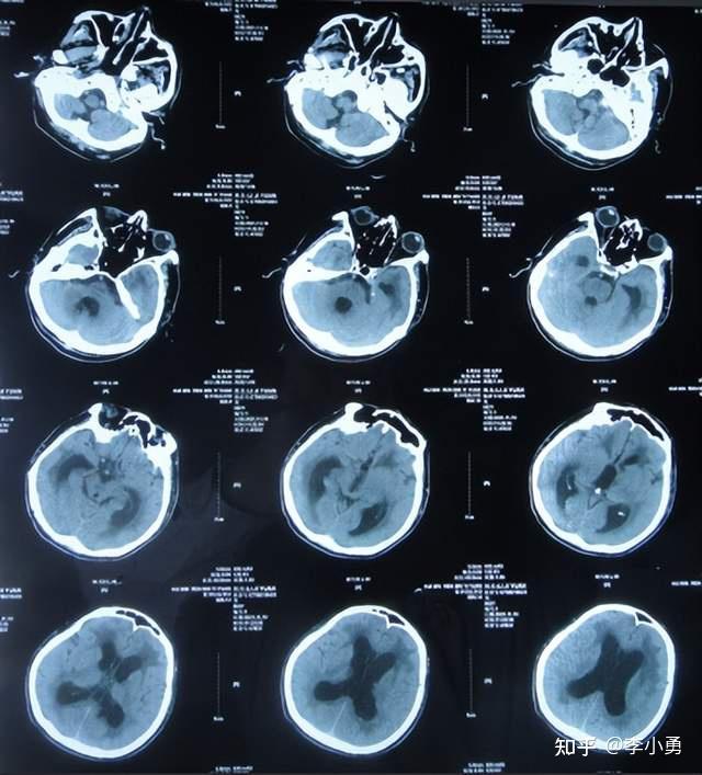 出院时头颅ct示仍有脑积水(图-9);出院时:意识差,不能走路,不能言语