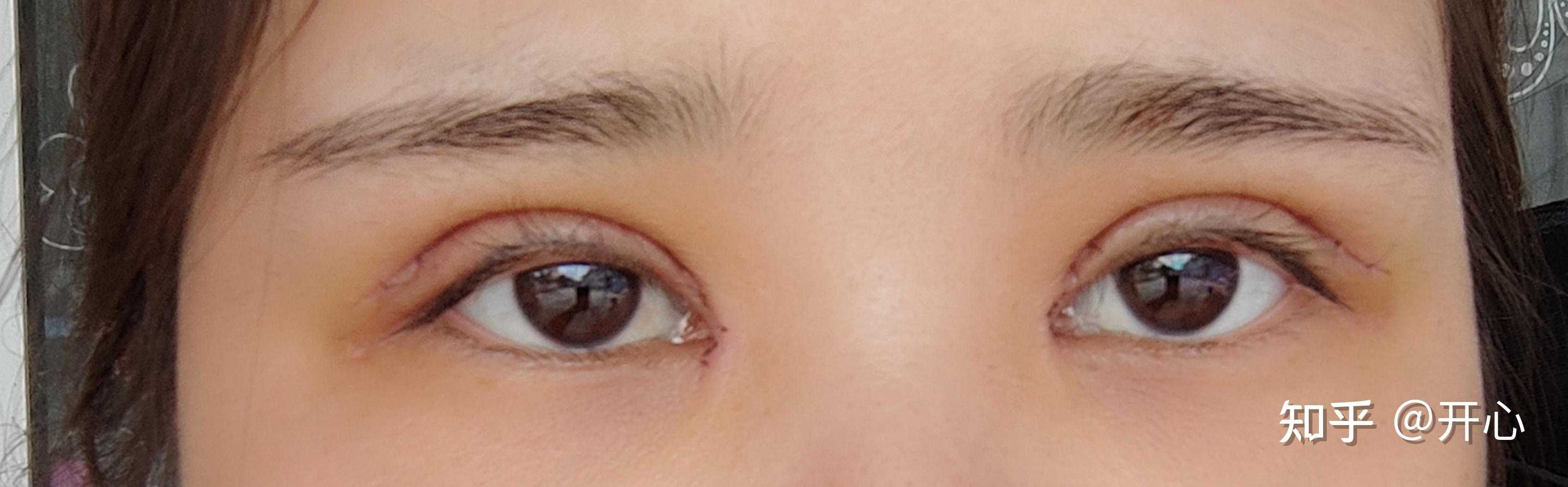记录全切双眼皮+开内眼角恢复过程 - 知乎