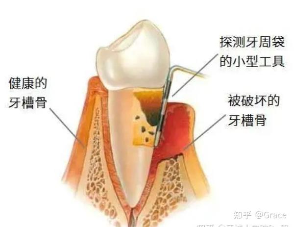 科普-牙周炎及治疗 - 知乎