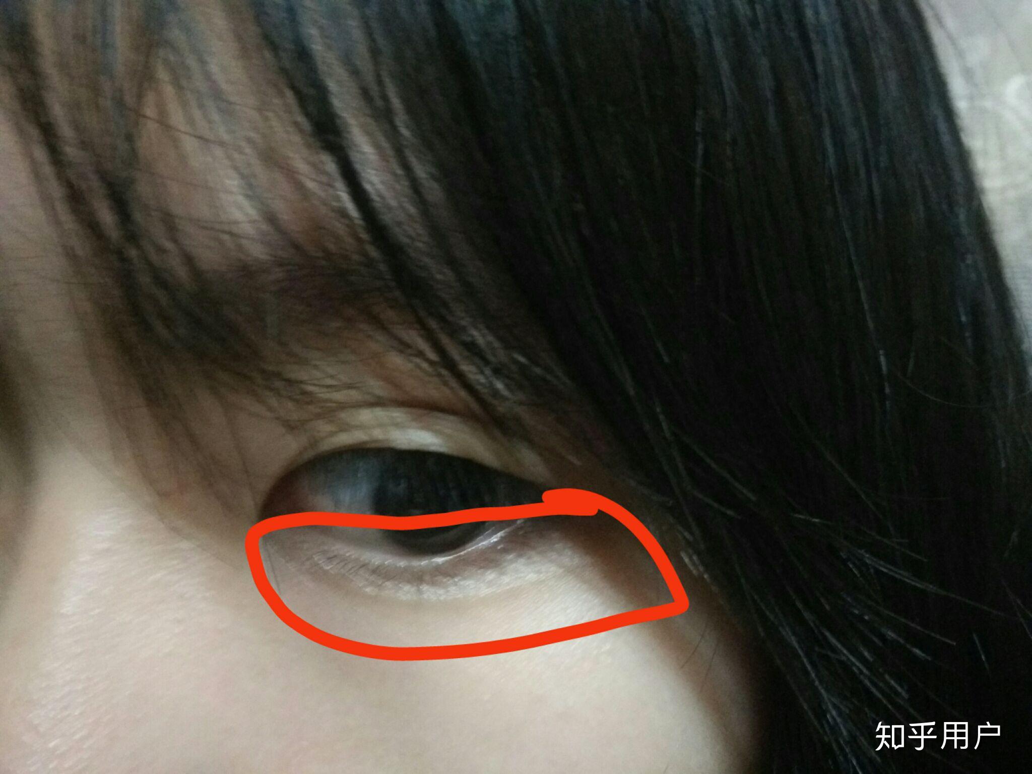 眼睛下放有一条线这个是什么