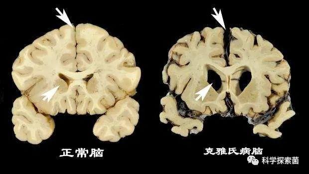 恐怖的库鲁病致死率100竟是当地土著分食同类遗体导致的